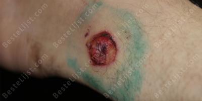 zelf toegebrachte schotwond films