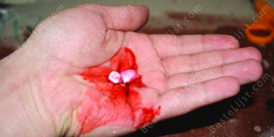 tanden eruit geslagen films