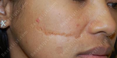 gezichtslitteken films