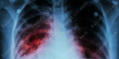 tuberculose films tuberculose films