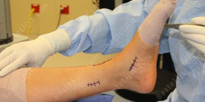 achillespees doorgesneden films